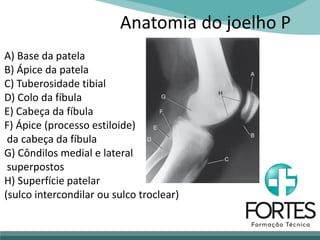 Anatomia do joelho P
A) Base da patela
B) Ápice da patela
C) Tuberosidade tibial
D) Colo da fíbula
E) Cabeça da fíbula
F) Ápice (processo estiloide)
da cabeça da fíbula
G) Côndilos medial e lateral
superpostos
H) Superfície patelar
(sulco intercondilar ou sulco troclear)
 