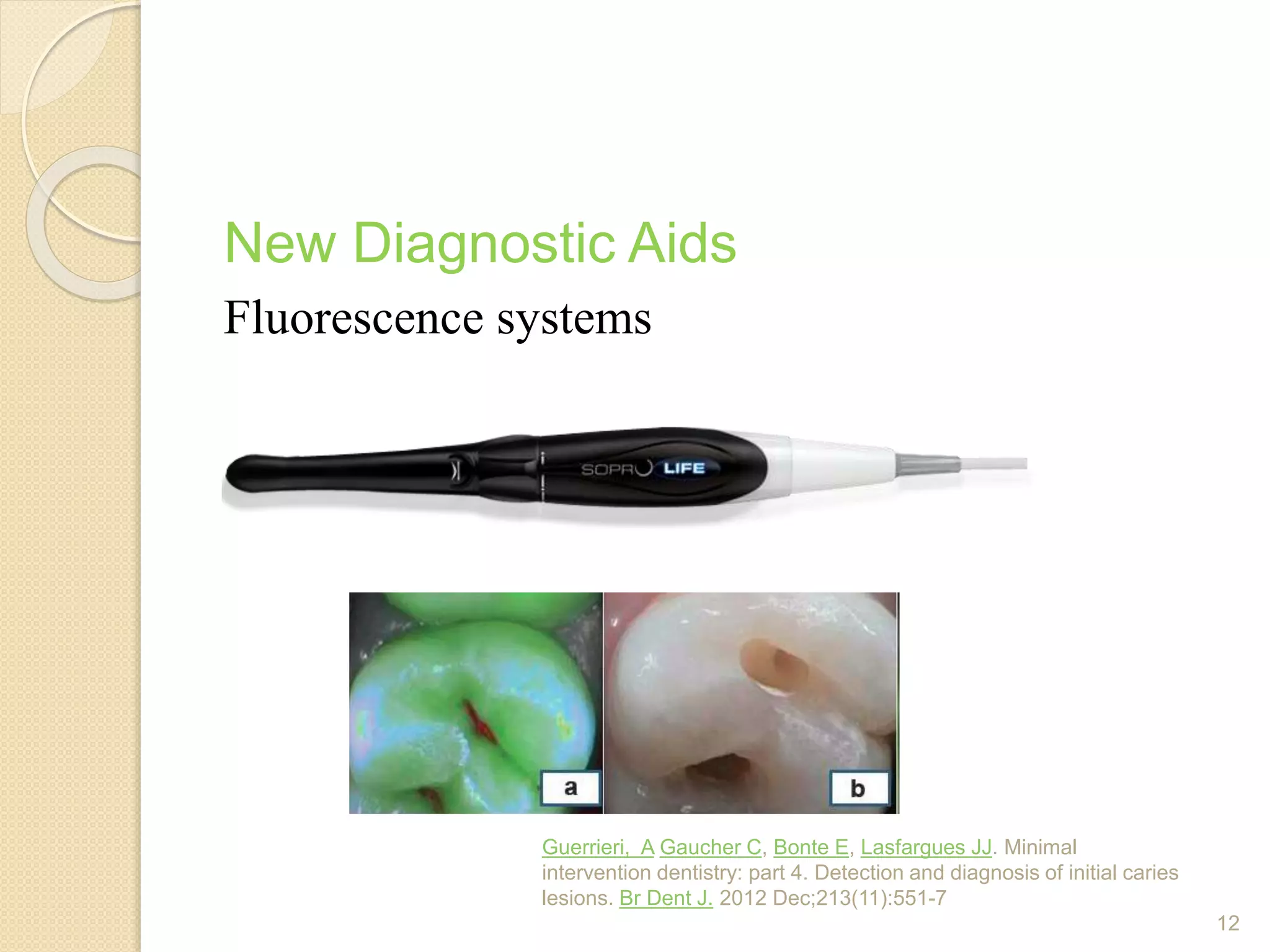 New Diagnostic Aids
Fluorescence systems
Guerrieri, A Gaucher C, Bonte E, Lasfargues JJ. Minimal
intervention dentistry: part 4. Detection and diagnosis of initial caries
lesions. Br Dent J. 2012 Dec;213(11):551-7
12
 