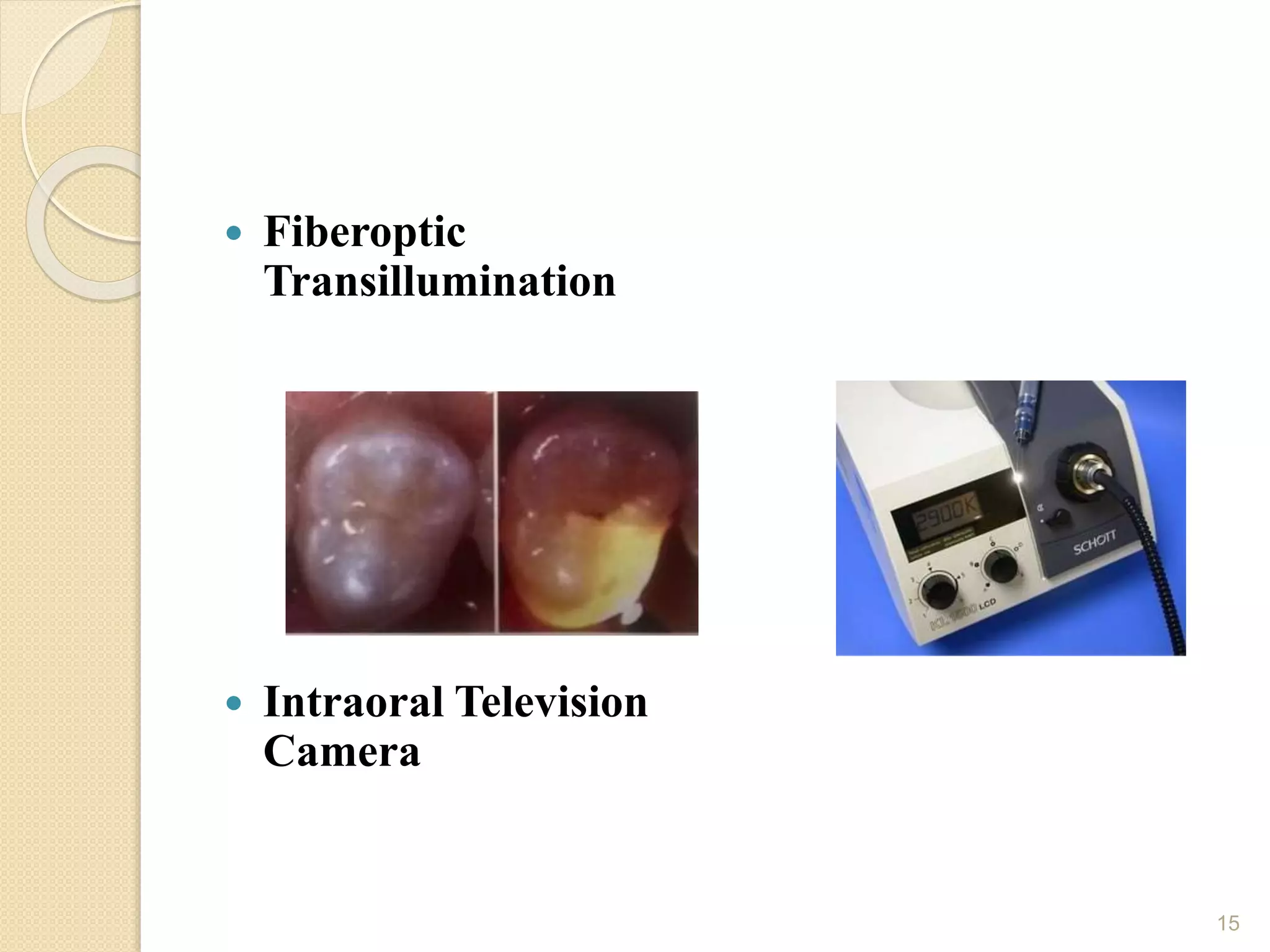  Fiberoptic
Transillumination
 Intraoral Television
Camera
15
 