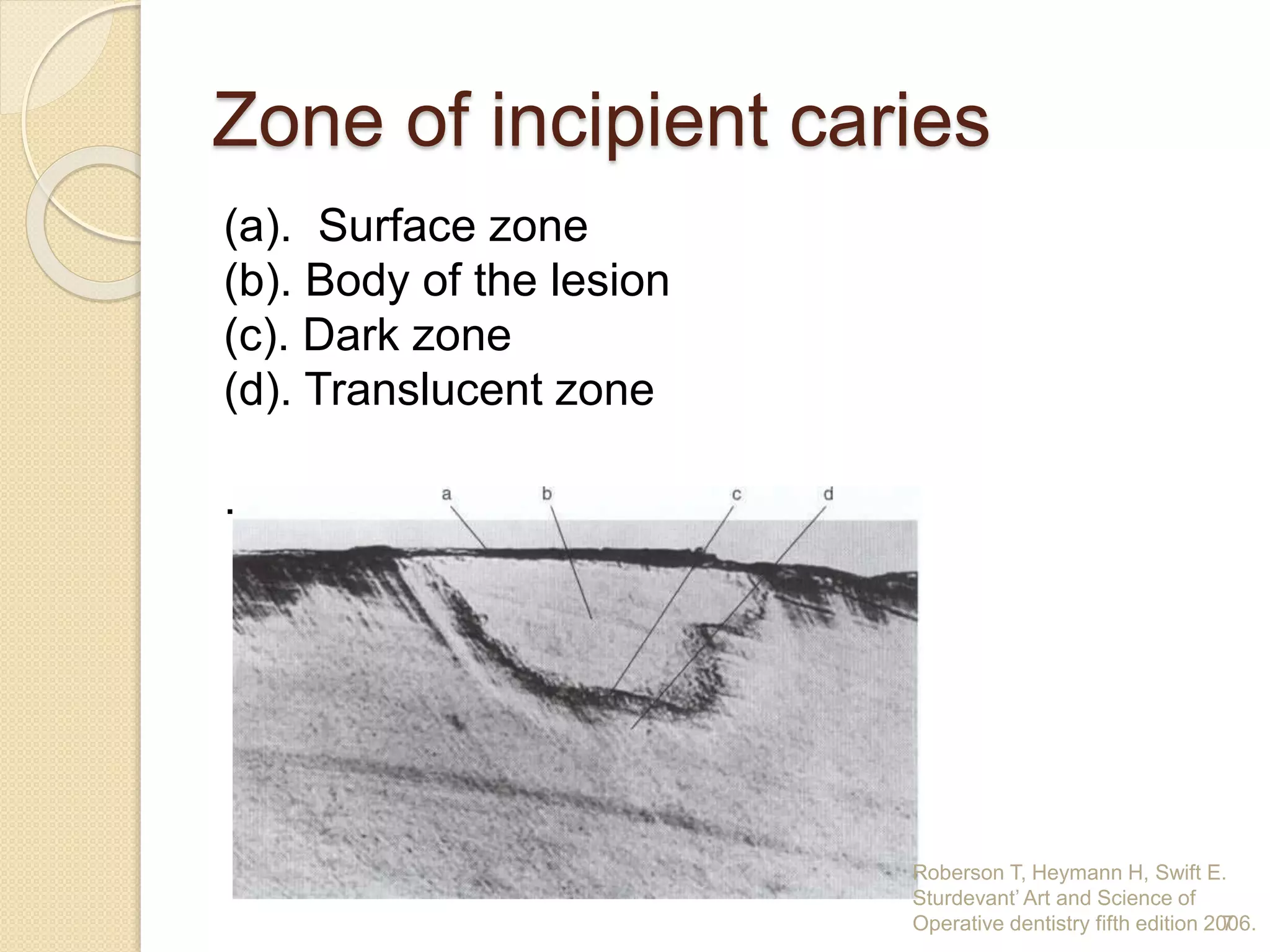 Zone of incipient caries
(a). Surface zone
(b). Body of the lesion
(c). Dark zone
(d). Translucent zone
.
7
Roberson T, Heymann H, Swift E.
Sturdevant’ Art and Science of
Operative dentistry fifth edition 2006.
 