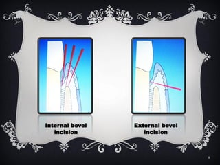 Oval Incision incision.pdf