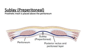 Sublay Retrorectus Comprehensive Management of Incisional Hernia and Loss of Domain | PPTX