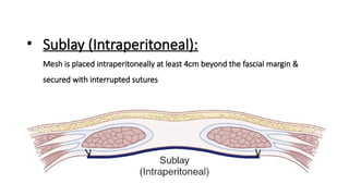 Sublay Only Comprehensive Management of Incisional Hernia and Loss of Domain | PPTX