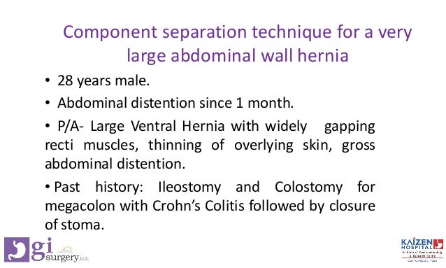 Component Separation Technique For A Very Large Abdominal Wall Hernia