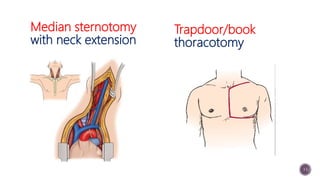 Strnotomy Incision and chest exposure in emergency | PPTX