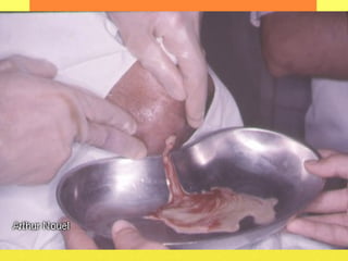 INCISION AND DRAINAGE