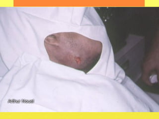 INCISION AND DRAINAGE