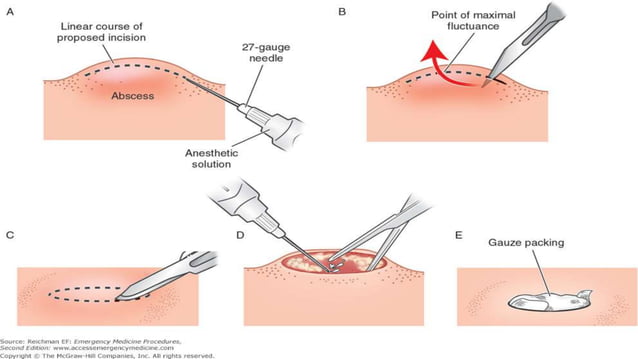 Incision and drainage | PPT