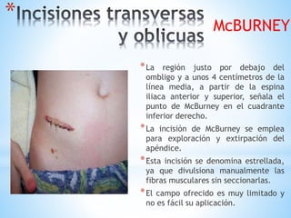 *
*La región justo por debajo del
ombligo y a unos 4 centímetros de la
línea media, a partir de la espina
iliaca anterior y superior, señala el
punto de McBurney en el cuadrante
inferior derecho.
*La incisión de McBurney se emplea
para exploración y extirpación del
apéndice.
*Esta incisión se denomina estrellada,
ya que divulsiona manualmente las
fibras musculares sin seccionarlas.
*El campo ofrecido es muy limitado y
no es fácil su aplicación.
McBURNEY
 