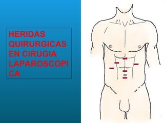 Incisiones doble | PPT
