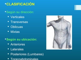 Incisiones doble | PPT
