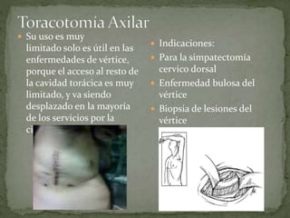  Su uso es muy
limitado solo es útil en las
enfermedades de vértice,
porque el acceso al resto de
la cavidad torácica es muy
limitado, y va siendo
desplazado en la mayoría
de los servicios por la
cirugía endoscópica.
 Indicaciones:
 Para la simpatectomía
cervico dorsal
 Enfermedad bulosa del
vértice
 Biopsia de lesiones del
vértice
 