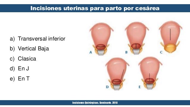 incisiones quirurgicas cesarea incisiones quirurgicas cesarea