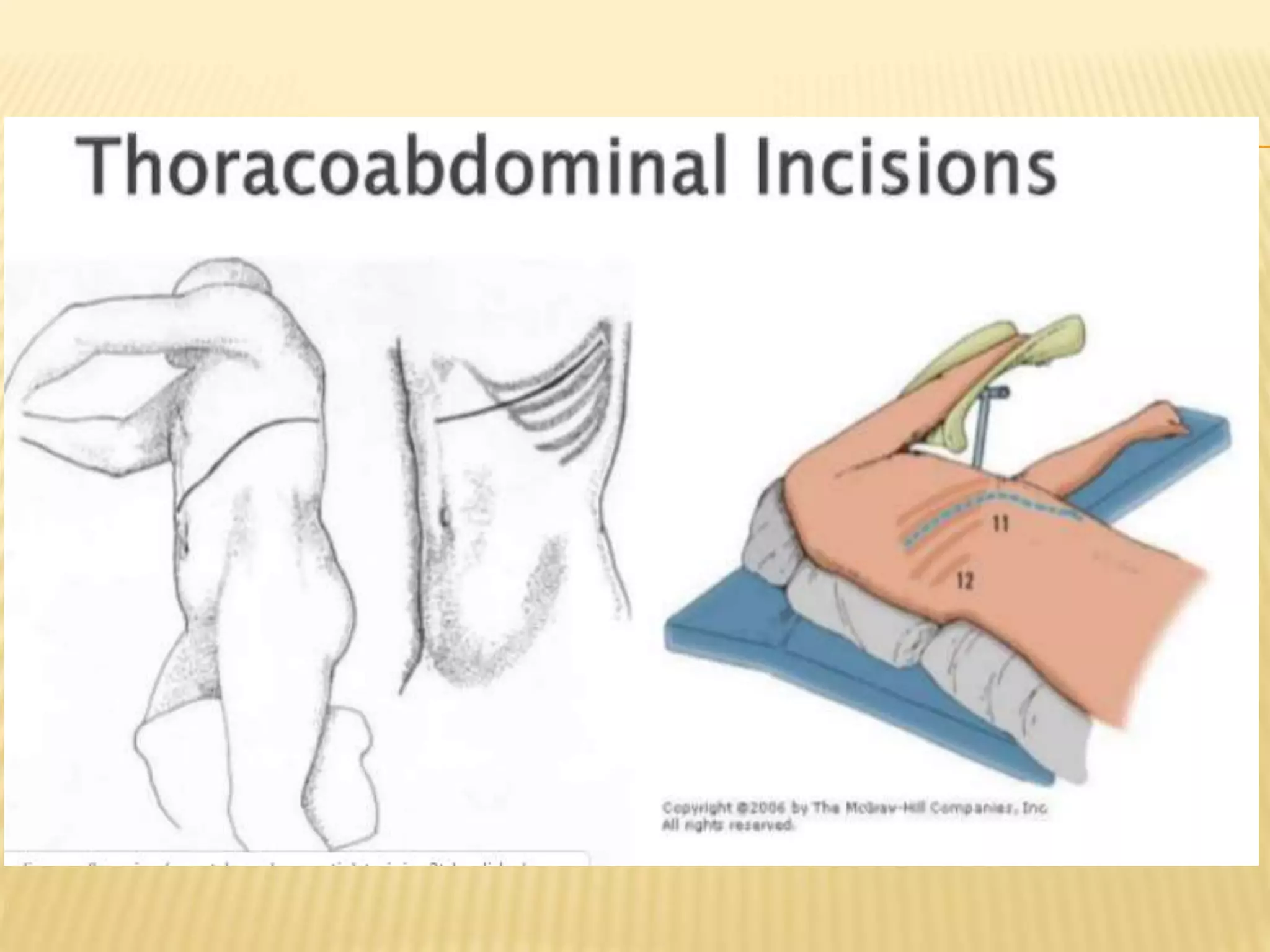 surgical Incisions - sadeghi mazloumi | PPTX
