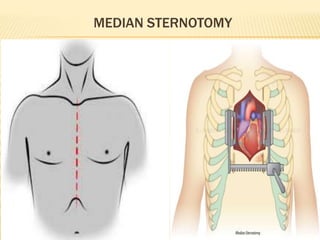 surgical Incisions - sadeghi mazloumi | PPTX