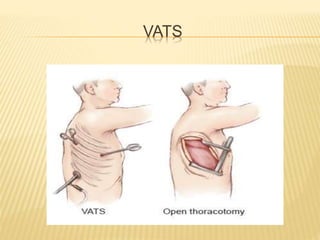 surgical Incisions - sadeghi mazloumi | PPTX