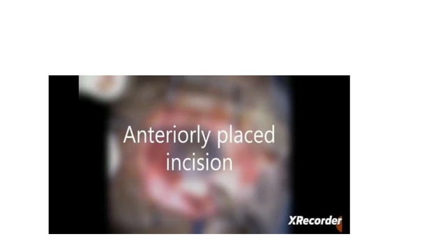 INCISIONS IN CATARACT SURGERY.pptx