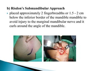 Two Fingerbreadths Incisions in head and neck region | PPTX