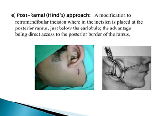 Dorsal Racket Incision Incisions in head and neck region | PPTX