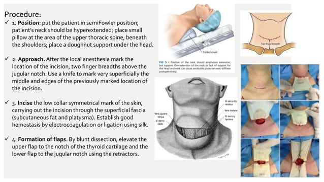 Lahey Incision Incisions in the neck, thyroidectomy, parathyroidectomy | PPTX