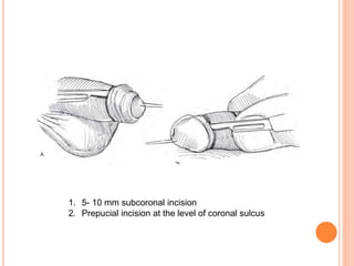 Subcoronal Incision Incisions in Urology.pptx
