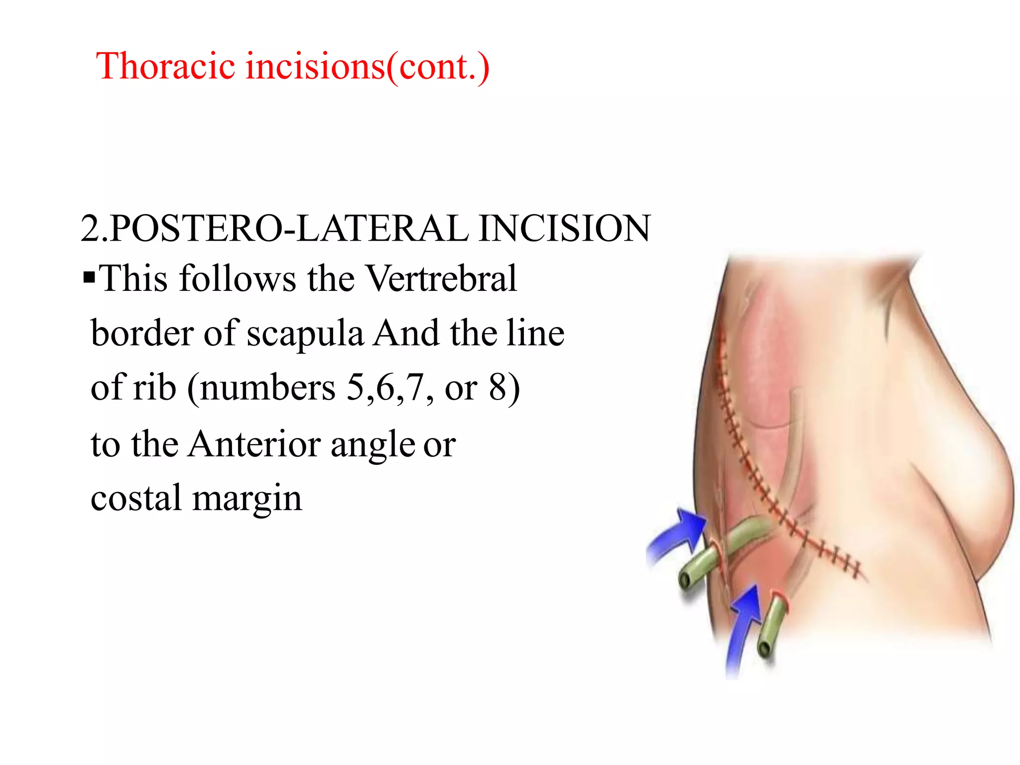 Lateral Incision Meaning Abdominal incision | PPTX