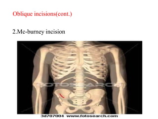 Abdominal incision | PPTX