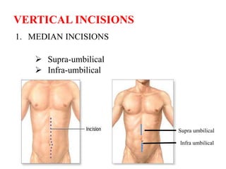 1. MEDIAN INCISIONS
 Supra-umbilical
 Infra-umbilical
VERTICAL INCISIONS
Supra umbilical
Infra umbilical
 