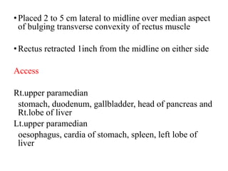 •Placed 2 to 5 cm lateral to midline over median aspect
of bulging transverse convexity of rectus muscle
•Rectus retracted 1inch from the midline on either side
Access
Rt.upper paramedian
stomach, duodenum, gallbladder, head of pancreas and
Rt.lobe of liver
Lt.upper paramedian
oesophagus, cardia of stomach, spleen, left lobe of
liver
 