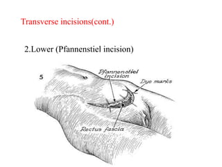 2.Lower (Pfannenstiel incision)
Transverse incisions(cont.)
 