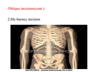 2.Mc-burney incision
Oblique incisions(cont.)
 