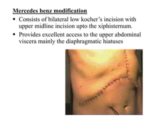 Mercedes benz modification
 Consists of bilateral low kocher’s incision with
upper midline incision upto the xiphisternum.
 Provides excellent access to the upper abdominal
viscera mainly the diaphragmatic hiatuses
 