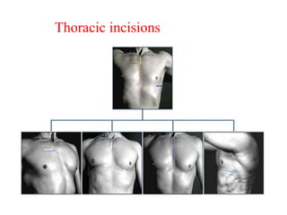 Thoracic incisions
 