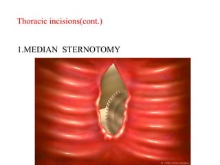 1.MEDIAN STERNOTOMY
Thoracic incisions(cont.)
 