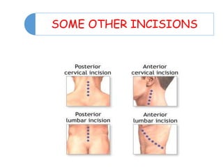 SOME OTHER INCISIONS
 