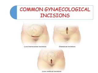 COMMON GYNAECOLOGICAL
INCISIONS
 
