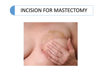 INCISION FOR MASTECTOMY
 