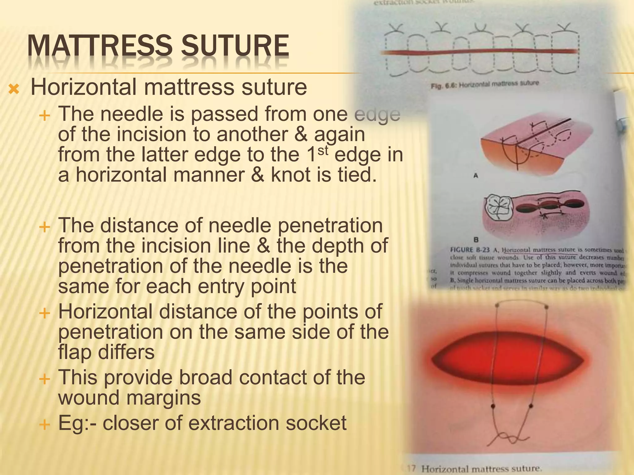 Incision, suture & suture meteri al | PPTX