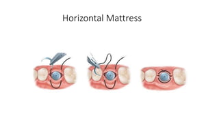 Incision Suturing Techniques And Complications pptx incision-suturing-techniques-and-complications-pptx