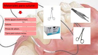 Materiales para suturar.
Porta agujas (Castroviejo).
Sutura.
Pinzas de adson.
Tijera para sutura rectas.
 