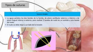 Tipos de suturas
Sutura simple:
• La aguja penetra los dos bordes de la herida, de plano vestibular externo a interno y de
plano lingual interno a externo, para realizar 2 lazadas de nudo en un sentido y una lazada
del revés.
• El nudo se debe dejar a un lado de la incisión
 