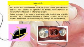 Sutura en X:
• Esta sutura está recomendada en la sutura del alveolo postextracción
debido a que además de aproximar los bordes puede mantener el
material hemostático en el interior del alveolo.
• Es una sutura en X., en la que la aguja penetra los dos labios de la herida
entrando por la zona mesiovestibular y saliendo por disto lingual, para
volver a introducirse desde mesiolingual y emerger por distovestibular.
 