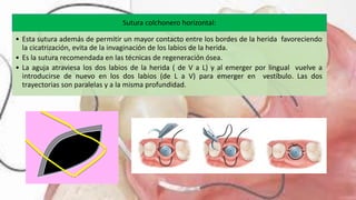 Sutura colchonero horizontal:
• Esta sutura además de permitir un mayor contacto entre los bordes de la herida favoreciendo
la cicatrización, evita de la invaginación de los labios de la herida.
• Es la sutura recomendada en las técnicas de regeneración ósea.
• La aguja atraviesa los dos labios de la herida ( de V a L) y al emerger por lingual vuelve a
introducirse de nuevo en los dos labios (de L a V) para emerger en vestíbulo. Las dos
trayectorias son paralelas y a la misma profundidad.
 