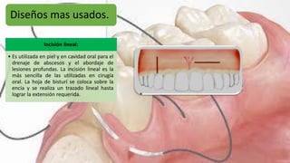 Diseños mas usados.
Incisión lineal:
• Es utilizada en piel y en cavidad oral para el
drenaje de abscesos y el abordaje de
lesiones profundas. La incisión lineal es la
más sencilla de las utilizadas en cirugía
oral. La hoja de bisturí se coloca sobre la
encía y se realiza un trazado lineal hasta
lograr la extensión requerida.
 