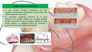 Colgajo trapezoidal o Newman
• Es una incisión marginal combinada con dos
relajantes horizontales divergentes que permite una
amplia exposición del hueso.
• Las incisiones relajantes verticales en la zona
posterior del paladar deben ser evitadas porque
pueden seccionar la arteria palatina anterior lo cual
puede generar un sangrado difícil de controlar y
producir necrosis por isquemia del tejido
 