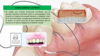 Incisión semilunar o de Partch:
• Se realiza una incisión horizontal curvilínea, con la
porción convexa orientada hacia la zona gingival. Esta
incisión en media luna puede hacerse a cualquier nivel
de la mucosa bucal, aunque para favorecer el acceso a
la lesión, se hace cerca de la zona operatoria, por lo
menos en el diente adyacente al diente a tratar
 