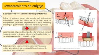 Levantamiento de colgajo
El periostotomo debe utilizarse de la siguiente forma:
Aplicar el extremo romo más amplio del instrumento,
insinuándolo entre los labios de la incisión entre el
mucoperiostio y el hueso, empezando en la encía adherida y
en el ángulo que forman las incisiones horizontal y vertical
La concavidad del periostótomo debe estar orientada hacia el
hueso para evitar el desgarro o la perforación del colgajo. La
parte convexa se coloca contra el colgajo.
Deben ejecutarse tres movimientos: empujar, levantar y
retirar. Normalmente hacemos también movimientos de
lateralidad muy cuidadosos
 
