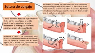 Sutura de colgajo
Con las pinzas de disección sujetamos uno
de los bordes cruentos de la herida
quirúrgica e introducimos la aguja
montada en el portaagujas en todo su
grosor y a unos 4 a 8 mm del borde
Retiramos la aguja y la remontamos para
introducir nuevamente desde la profundidad
hacia la superficie, siempre con el mismo
espesor, en la misma línea, equidistante del
borde, y con la curvatura adecuada
Finalmente se toma el hilo de sutura con la mano izquierda y
con el portaagujas en la mano derecha se efectúan los nudos
necesarios hasta aproximar los labios de la herida. Apretamos
el nudo con el portaagujas o con las manos y lo dejamos sobre
uno de los lados de la incisión.
 