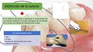 Definición de la sutura.
Es el material destinado a favorecer la cicatrización de
una herida mediante el cosido quirúrgico de los bordes
de la misma con objeto de mantenerlos unidos.
Las suturas pueden ser de:
• Hilo.
• Grapas.
• Bandas de cierre de piel (steri-strip).
• Adhesivos tópicos.
 