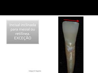 Incisal inclinada
para mesial ou
retilínea.
EXCEÇÃO
Caíque A. Siqueira
 